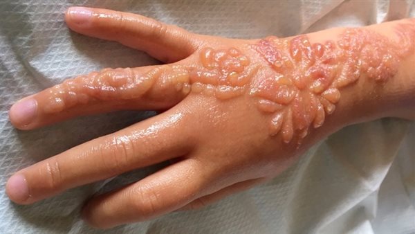 أضرار الحنة السوداء