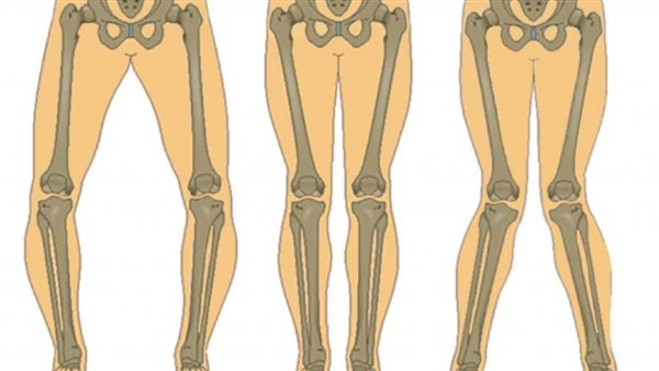 علاج تقوس الساقين