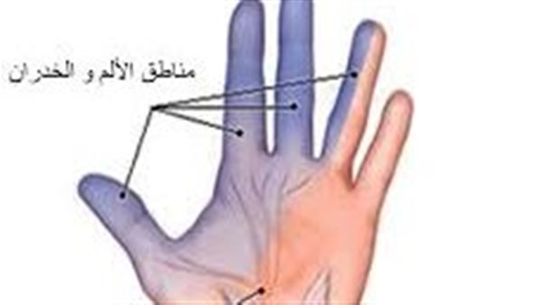 أعراض اختناق العصب