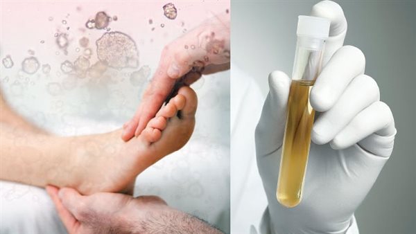أسباب ارتفاع اليوريك