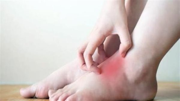 أعراض ارتفاع اليوريك