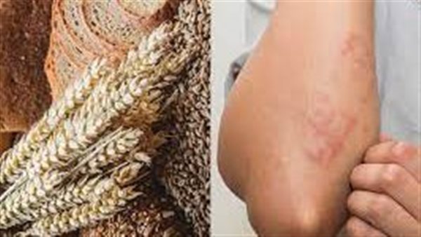 أعراض حساسية الجلوتين