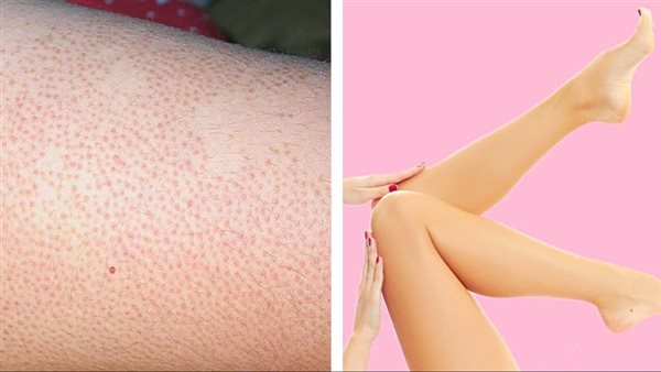 أرجل الفراولة.. أرشيفية