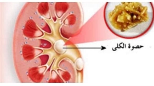 أعراض رمل الكلى