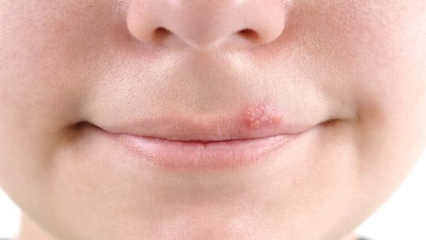 علاج داء كثرة الوحيدات