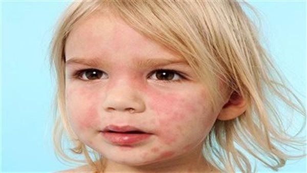 أعراض ضربة الشمس