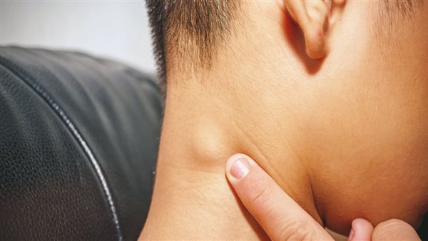 أعراض التهاب الغدد