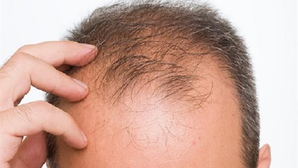 علاج تساقط الشعر..