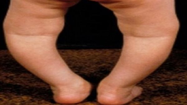 متى يحتاج طفلك لعلاج