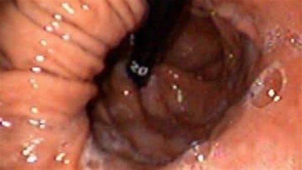 أعراض فتق الحجاب