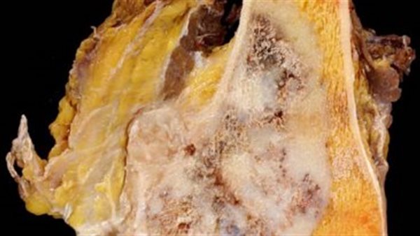 علاج الساركوما الغضروفية
