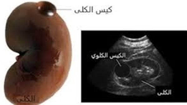 علاج التكيسات الكلوية