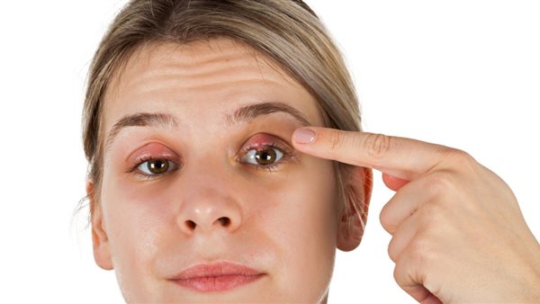 أعراض شعيرة العين
