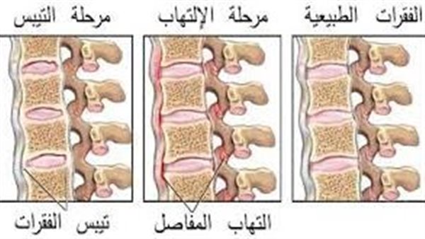ما هو التهاب الفقرات