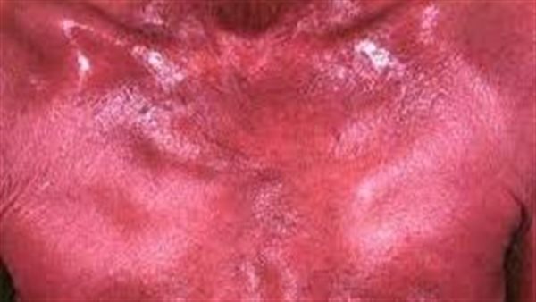 علاج متلازمة الرجل