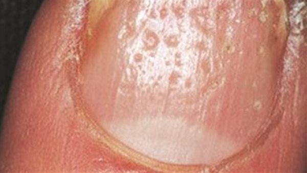 أعراض تقعر الأظافر
