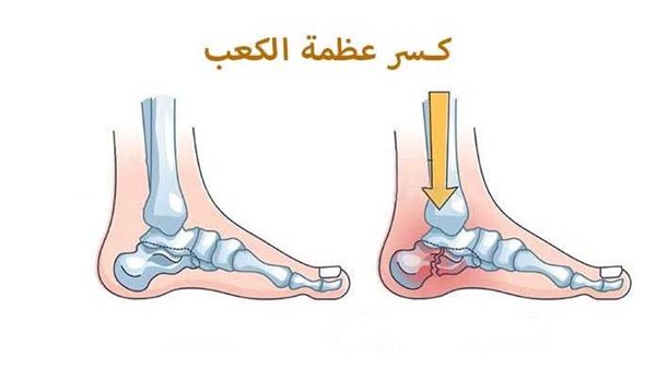 كسور عظمة الكعب..