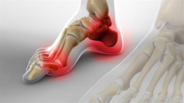 أعراض القدم الكهفية..