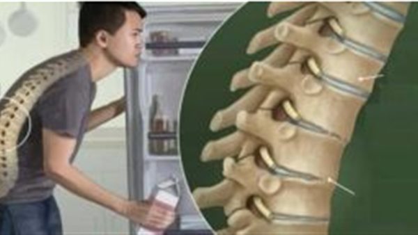 أعراض تصلب الفقرات