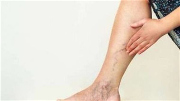 علاج متلازمة كليبل