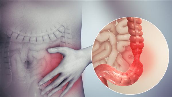 مرض التهاب الأمعاء..