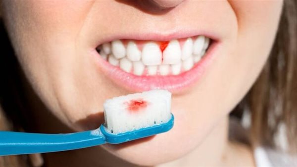 أعراض نقص الصفائح