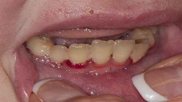 أعراض التهاب اللثة