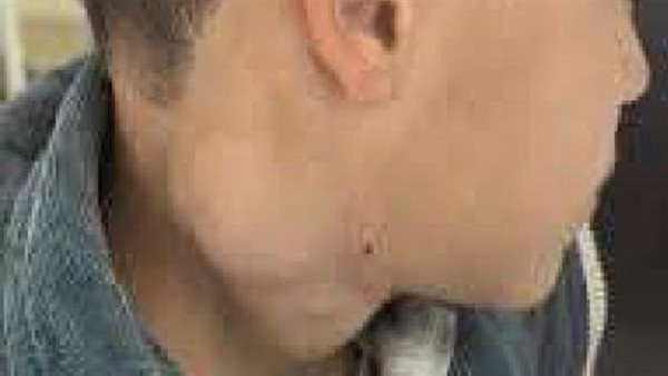 ما هي أعراض مرض هودجكن؟