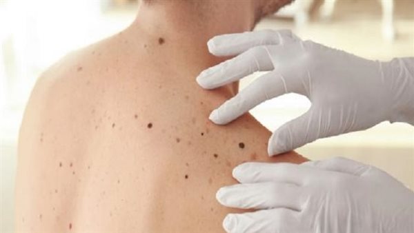 أعراض المايلوما المتعددة