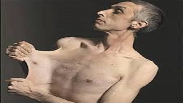 هل متلازمة اهلرز
