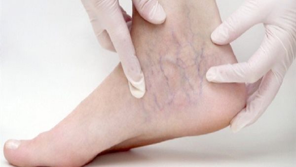 أعراض انتفاخ عروق