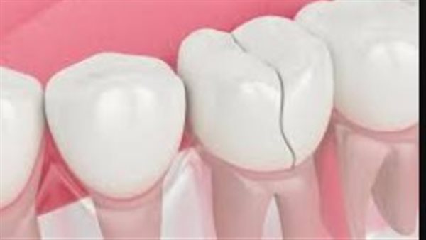أعراض ومضاعفات تشقق