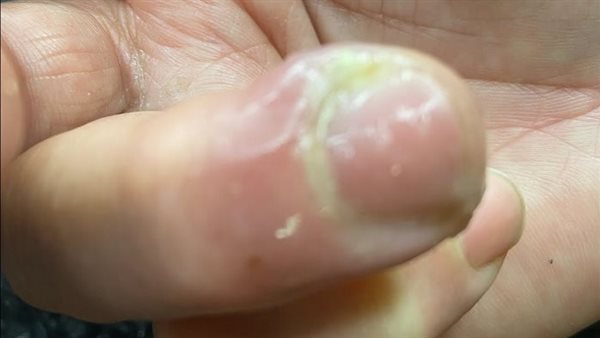 علاج الداحس في المنزل
