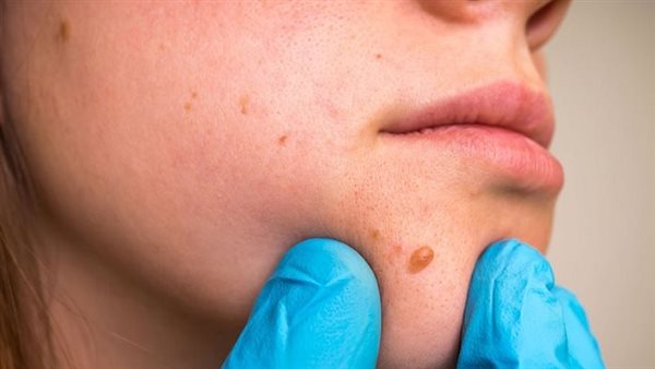 متى تظهر أعراض المليساء