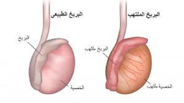 ما هو التهاب البربخ؟