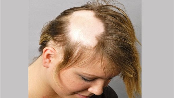 أعراض الثعلبة عند