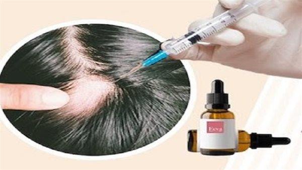 علاج الثعلبة عند