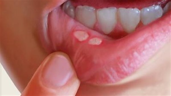 أعراض القرحة القلاعية