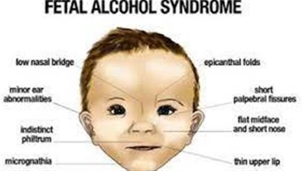 علاج متلازمة الجنين