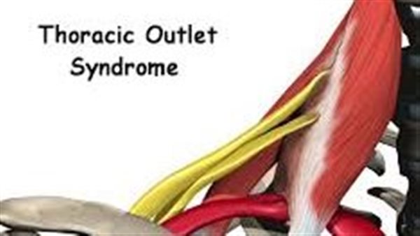 علاج متلازمة مخرج