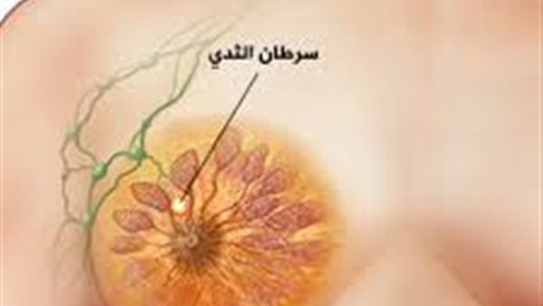 سرطان الثدي.. أرشيفية