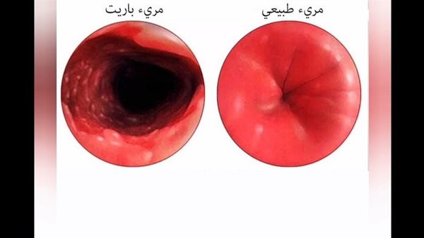 ما هو مريء باريت؟