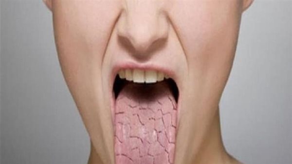 ما هي متلازمة شوغرن؟