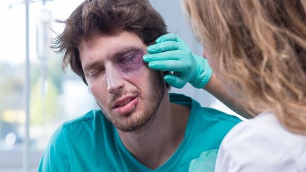علاج كدمات العين