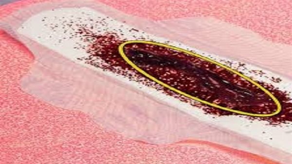 أعراض تخثر دم الحيض