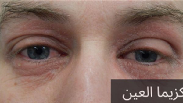 إكزيما الجفون