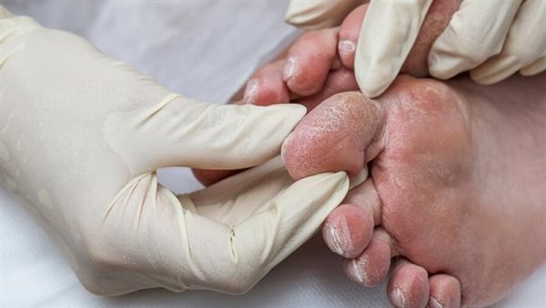 علاج التهاب الإصبع