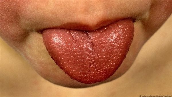 علاج لسان الفراولة