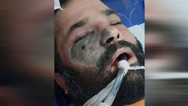 ما هي أعراض الفطر