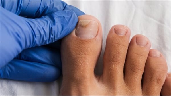 علاج انفصال الظفر